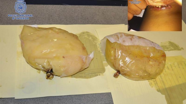 The implants were found to carry 1.38 kg of cocaine. Photo: EFE