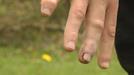 Así está el dedo fracturado de Irujo