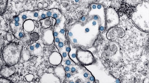 Una imagen microscópica de la infección del coronavirus(en azul)del primer paciente en EEUU.