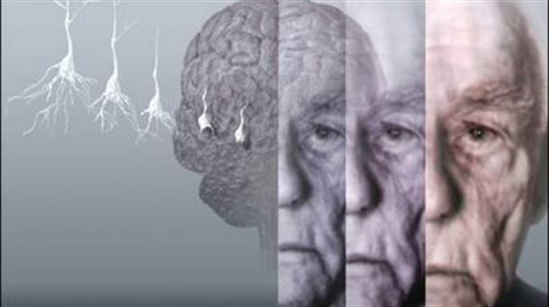Alzheimer. Fuente: BBC
