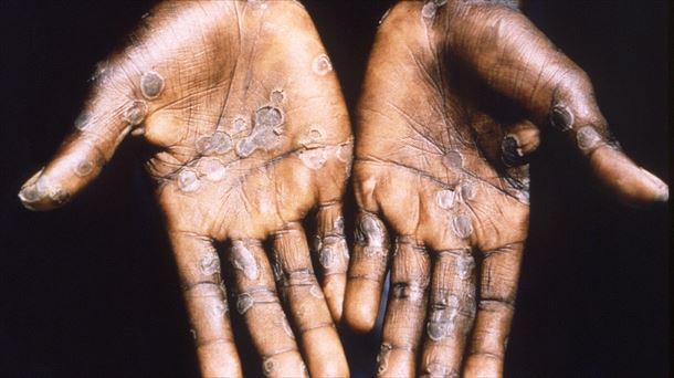 Lesiones en la piel provocadas por la viruela del mono. 